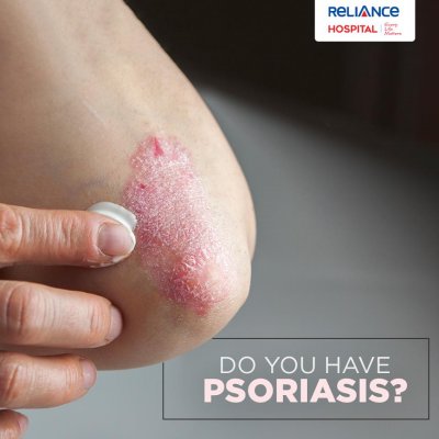 Do you have psoriasis?