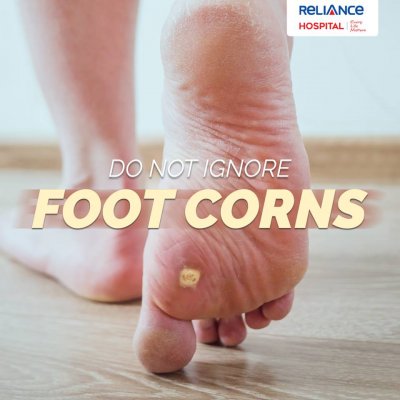 Do not ignore foot corns 