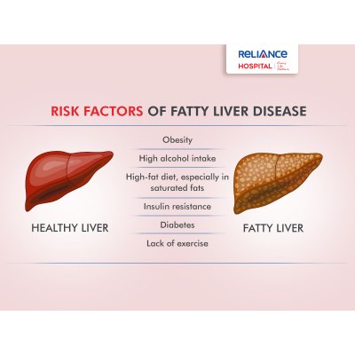 Risk factors of fatty liver disease