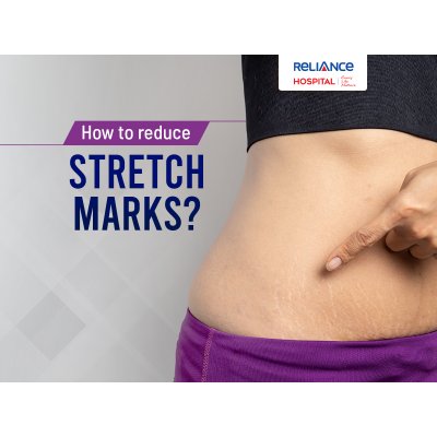 How to reduce stretchmarks?