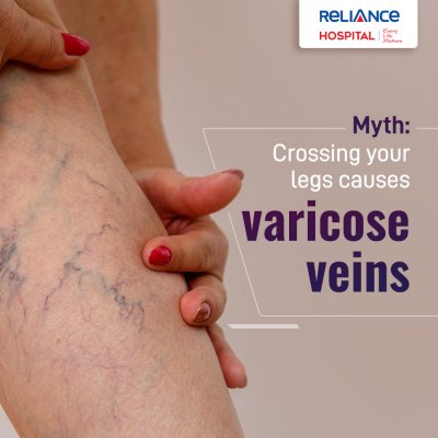 Myth - Crossing your legs causes varicose veins 