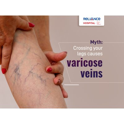Myth - Crossing your legs causes varicose veins 