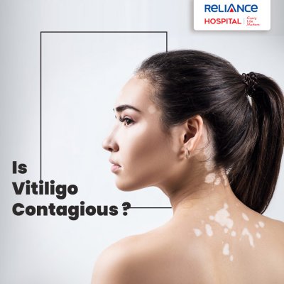 Is Vitiligo contagious? 